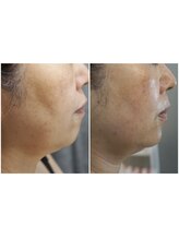 エイジングケア専門サロン サンク(thanq)/フェイスライン・二重あごケア