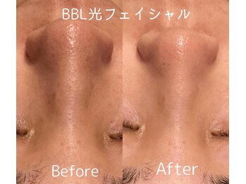 ラブ美長寿 沖縄本店(Lab)/ビフォーアフター光フェイシャル