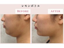 レクラ バイ ドクターエイチ(L'ECLAT by Doctor.H)/レモンボトル