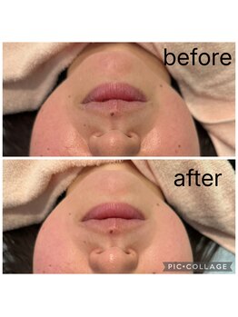 レイモード(Ray mode)/BBLフェイシャル＆パック