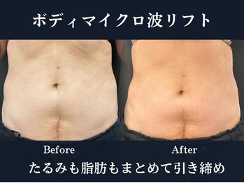 イロハ(IROHA)の写真/深部加温で脂肪にアプローチ、引き締めと巡り改善で理想のボディラインへ導きます!