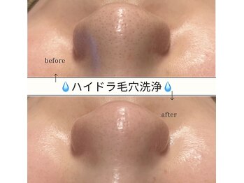 ルナビューティー 赤坂(LUNA beauty)/ハイドラ毛穴洗浄