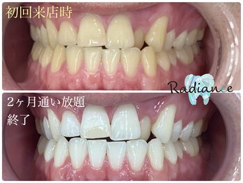 札幌セルフホワイトニング ラディアンス(Radiance)/札幌セルフホワイトニング