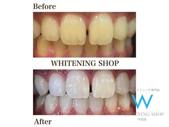 ホワイトニングショップ 甲賀店/Before&After『ホワイトニング』
