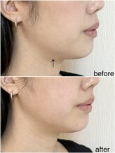 毛穴塾/話題の小顔マイクロリフト