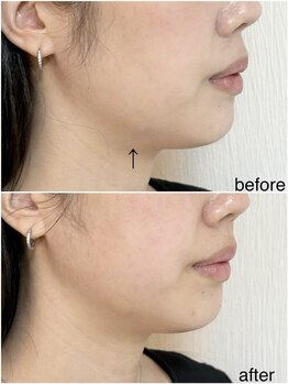 毛穴塾/話題の小顔マイクロリフト