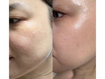 ビオラス(VIOLUS)/30代女性/毛穴ケア