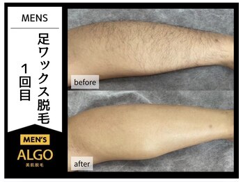 アルゴ 福井店(ALGO)/気になる足もワックス脱毛！