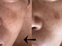 サロン ドロップ 上小田井(Salon drop)/「シミ改善」