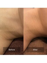 ビビ(VIVI)/首のざらつきにも☆