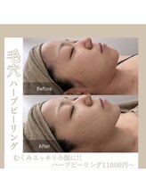 ビューティリュクス(beauty luxe)/DT無し/ハーブピーリング