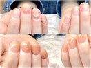 劇 的☆深爪改善！before→after