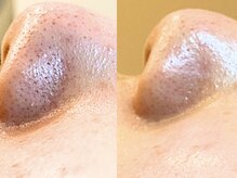 ミエリア美容鍼灸院(mielia美容鍼灸院)/小鼻つや！超音波で上質毛穴ケア