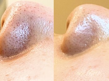 ミエリア美容鍼灸院(mielia美容鍼灸院)/小鼻つや!超音波で上質毛穴ケア