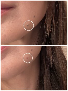 ミエル(miel)/ポッロっと取れるシミケア