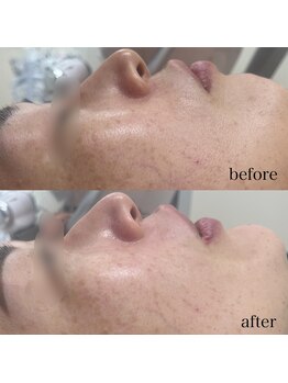 ソルシエール/毛穴×そり