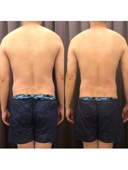 エステサロン 美飾り イオンモール木更津店/before⇒after/脂肪分解注入