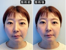 アオヤマ サロン ワイゼット(AOYAMA SALON YZ)/大人の小顔ケア