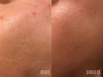 ウォーム(warm)/脱毛/顔脱毛/シェービング