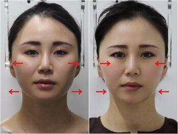 さつま骨格矯正 渋谷 恵比寿本院/歪み小顔矯正 初回効果