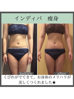 トータルビューティーサロン レビュー(REVIEW)/【Before/After】インディバ体