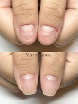 マリーロール 梅田店(Marie Laure)/自爪育成/深爪矯正/ネイルケア