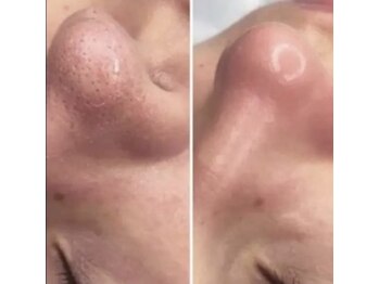 リラクゼーションアンドビューティーボヌール(BONHENR)/JETPEELの効果