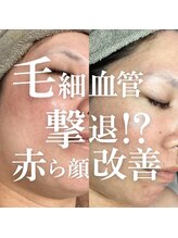 アムリリー 南草津店(AMRILY)/赤ら顔には毛細血管に反応