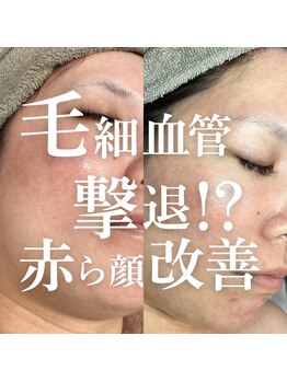 アムリリー 南草津店(AMRILY)/赤ら顔には毛細血管に反応