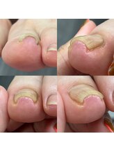 ウェルズユキ(well's yuki)/巻き爪