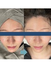 レベンディス(LEVENDIS)/ララピール