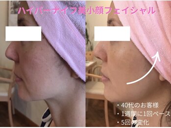 エステティックサロン アールグレー/ハイパーナイフ小顔フェイシャル