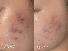 ウィハナ(wehana)/【ハーブピーリング】ニキビ