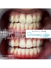 ホワイトニングサロン 福岡天神店/ホワイトニング