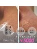【メンズ清潔感UPセット】ヒゲ脱毛&毛穴洗浄でツルツルに ¥6000→¥5000