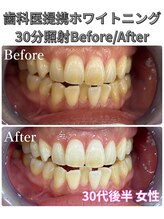 プラチナムビューティ 四条烏丸店(PLATINUM Beauty)/ホワイトニング！Before./After!