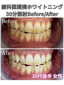 プラチナムビューティ 四条烏丸店(PLATINUM Beauty)/ホワイトニング!Before./After!