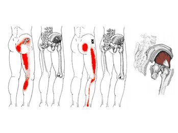 バズ カイロプラクティック(VAZ)/関連痛