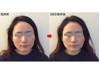 整体院プラス/小顔矯正モニター