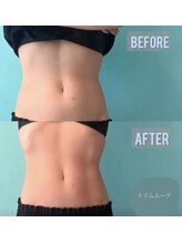 キノ(Kino)/脂肪冷却★プライムセラム導入