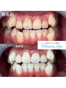 ホワイトニングサロン 熊本店/新市街セルフホワイトニング