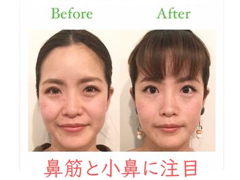 ラプリ 福岡天神店(Raplit)/隆鼻+輪郭・小顔矯正 美鼻/小顔