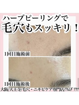 アルムダアクア 天王寺店(Aleumda AQUA)/毛穴エクストラクションプロ大阪
