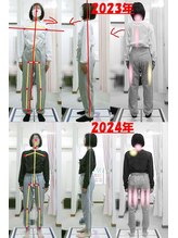 姫路なごみ整体院 なごみ鍼灸院/改善例：右座骨の神経の痛み