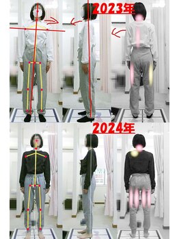 姫路なごみ整体院 なごみ鍼灸院/改善例：右座骨の神経の痛み