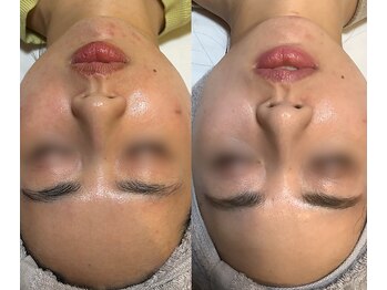 マザートウキョウ(Mother TOKYO)/色素ケアお任せください!4回