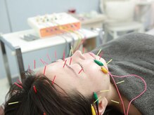 松本整骨院/電気美容鍼の様子