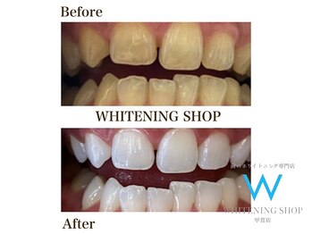 ホワイトニングショップ 甲賀店/Before&After『ホワイトニング』