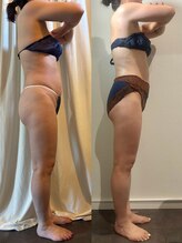 カルナ(CARNA)/【痩身】セルライトゼロ2