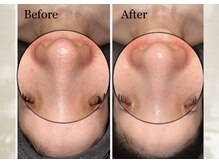 リリーシャ 赤坂(LILISHA)/開き毛穴1回でここまで引き締め